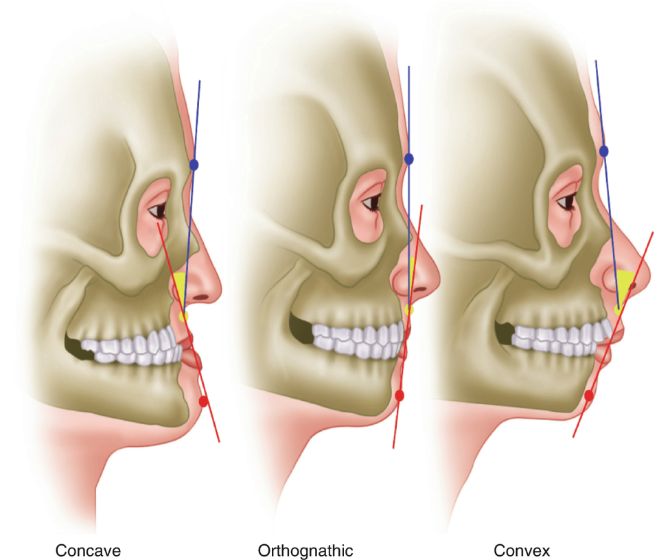 Creating Aesthetic Smile / Orthognathic Surgery / Jaw Correction Surgery