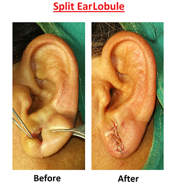Prominent Ear Correction / Ear Surgery Before & After