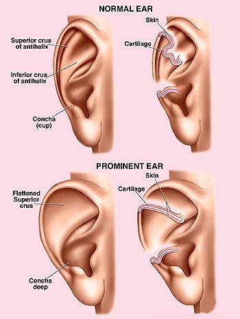 Otoplasty / Prominent (Bat) Ear Correction / Ear ReShaping