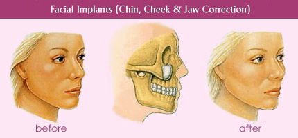 Facial Implants (Chin, Cheek & Jaw Correction)