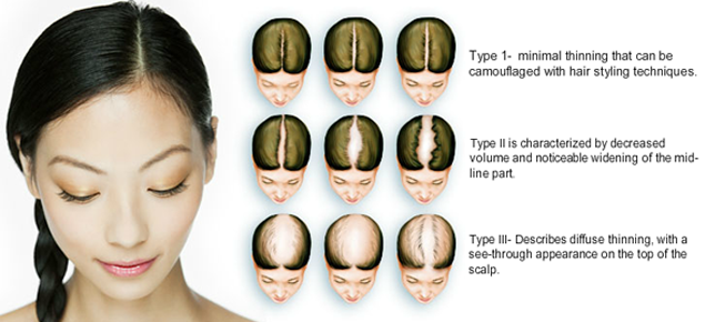 Female Pattern Baldness