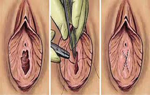 Hymenoplasty (Hymen Repair Surgery, Re-virgination)
