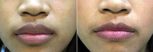 Lip Reduction / Reshaping