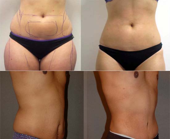 Liposuction – Body Shaping