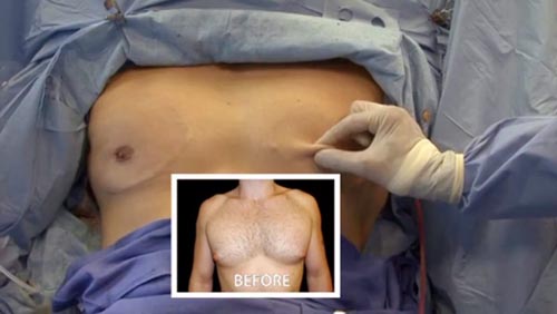 Puffy Nipples / Areolae in Men