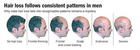 What is Male Pattern Baldness ?