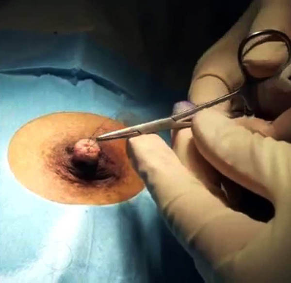 Breast and Nipple Reconstruction after Cancer Surgery