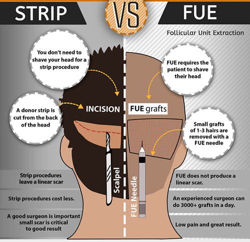 Hair Transplant Methods Strip vs FUE