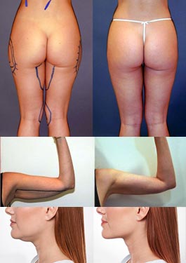 Liposuction – Thighs & Buttocks